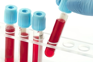 Xét nghiệm máu có phát hiện bệnh lậu không