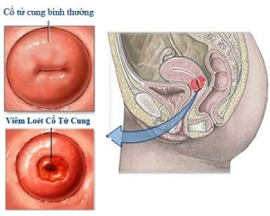 Nguyên nhân viêm cổ tử cung