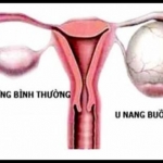 u nang buồng trứng phải có nguy hiểm không