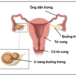 u nang buồng trứng trái